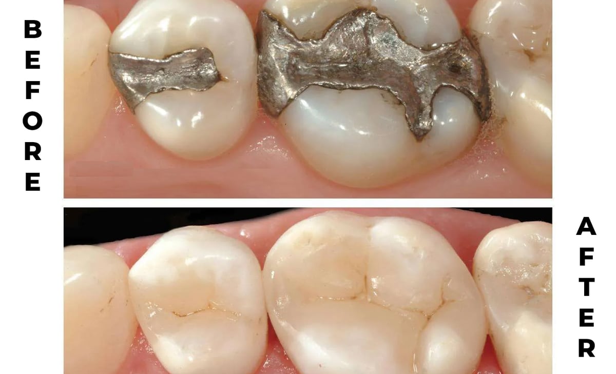 Composite “White” Fillings