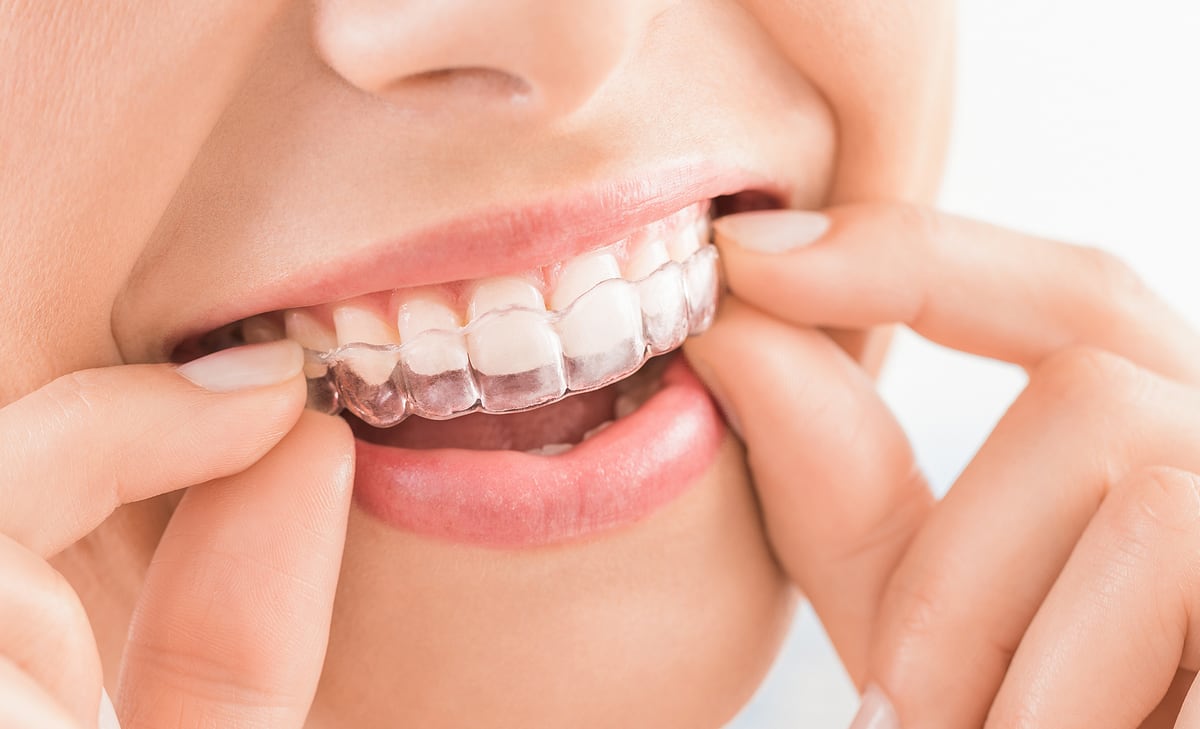 Clear Aligner Therapy (invisible braces): The “Clear” Alternative to Braces
